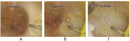 Various phases of hysteroscopic section of the uterine septum. 